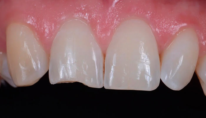 Composite restoration before polishing in DiaShine Lucida clinical case by Dr. Giuseppe Chiodera