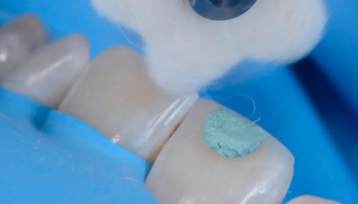 Intermediate polishing stage of composite restoration using DiaShine Lucida system