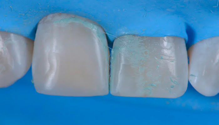 Close up of DiaShine Lucida polishing in action on composite restoration surface