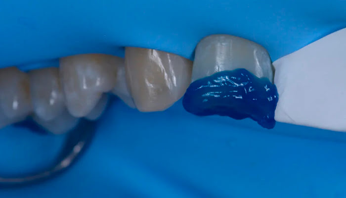 Clinical polishing demonstration with DiaShine Lucida system for composite finishing