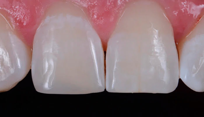 Finished composite restoration with high gloss after DiaShine Lucida polishing in clinical case by Dr. Giuseppe Chiodera