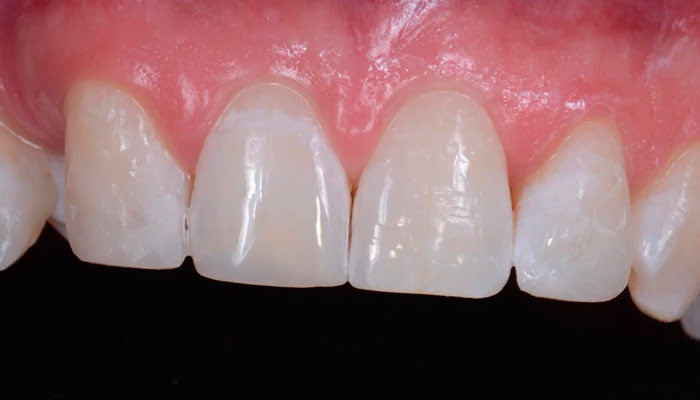 High gloss composite dental restoration result polished with DiaShine Lucida system