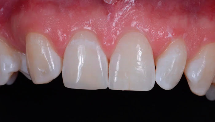 Final smooth and aesthetic composite restoration surface after DiaShine Lucida clinical polishing