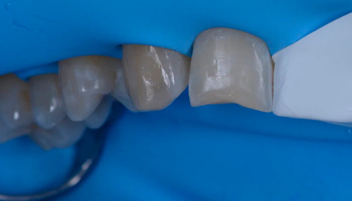 Initial composite finishing step with DiaShine Lucida polishing system in clinical case