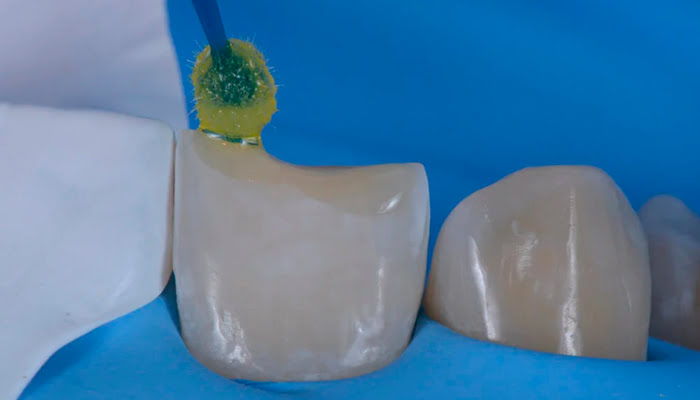 Dentist using DiaShine Lucida felt on handpiece for surface refinement