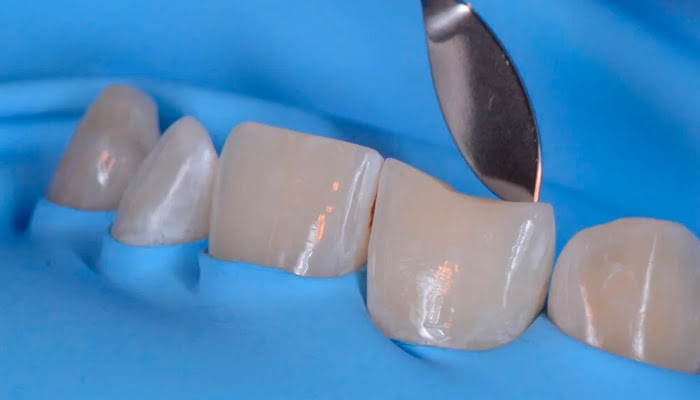 Progressive polishing of composite restoration with DiaShine Lucida discs and paste