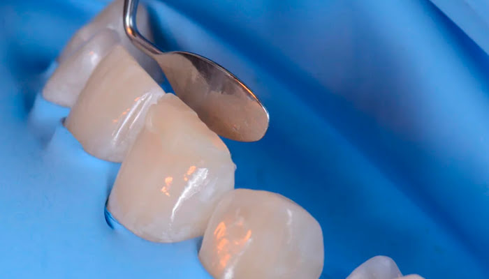 Clinician polishing composite restoration using DiaShine Lucida system in step by step sequence
