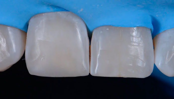 Polishing composite surface with DiaShine Lucida felt stars for improved smoothness