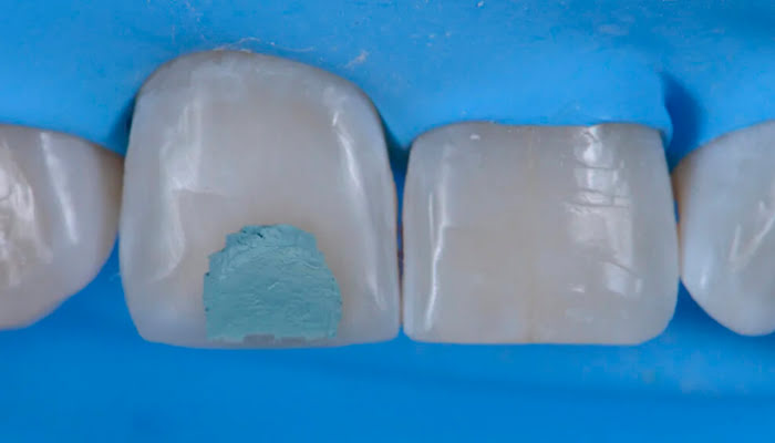 Dentist refining the composite restoration surface using DiaShine Lucida in clinical case