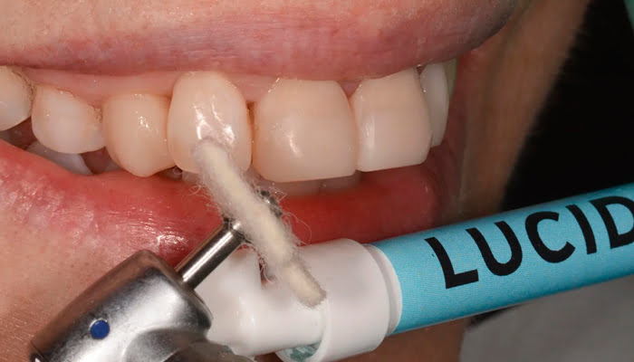 DiaShine Lucida polishing case by Dr. Monaldo Saracinelli showcasing high-gloss composite finishing