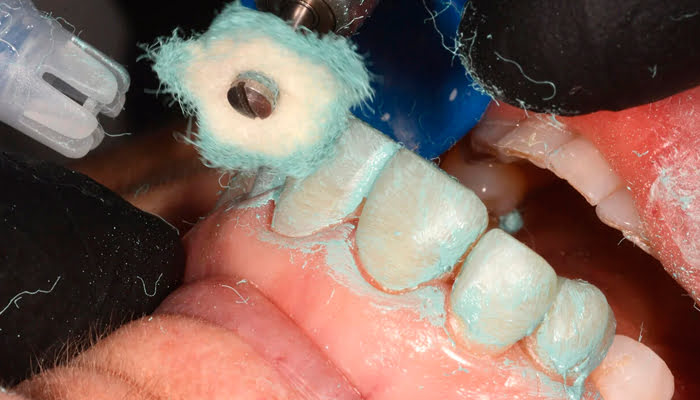 Dentist using DiaShine Lucida polishing system in clinical case for composite restoration surface finishing