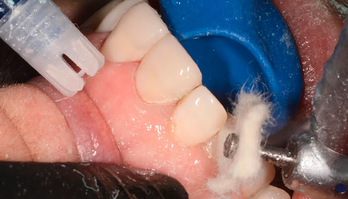 DiaShine Lucida polishing pastes and felt stars used in clinical composite finishing