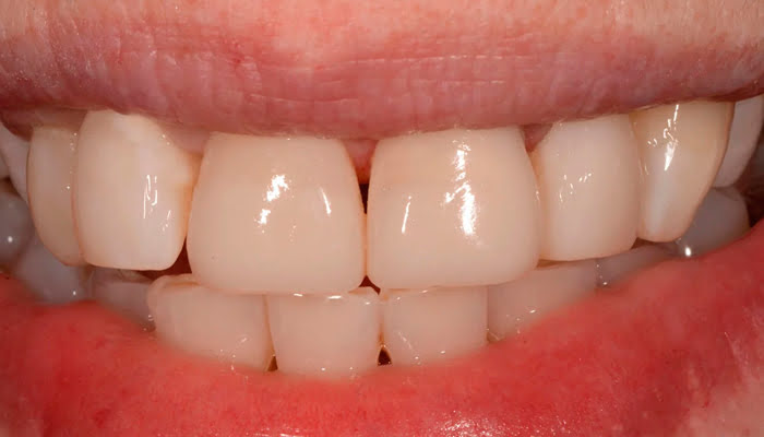 Close up of DiaShine Lucida polishing tools and accessories for dental finishing