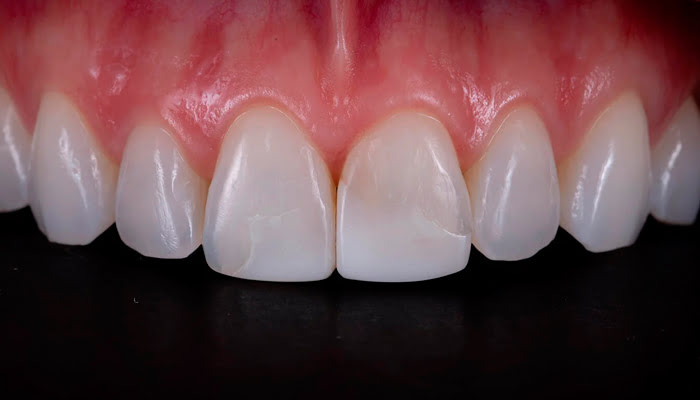 DiaShine Lucida clinical case by Dr. Monaldo Saracinelli showing composite restoration finishing with high gloss