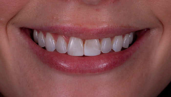 Finished composite restoration showing smooth surface and natural gloss after DiaShine Lucida polishing