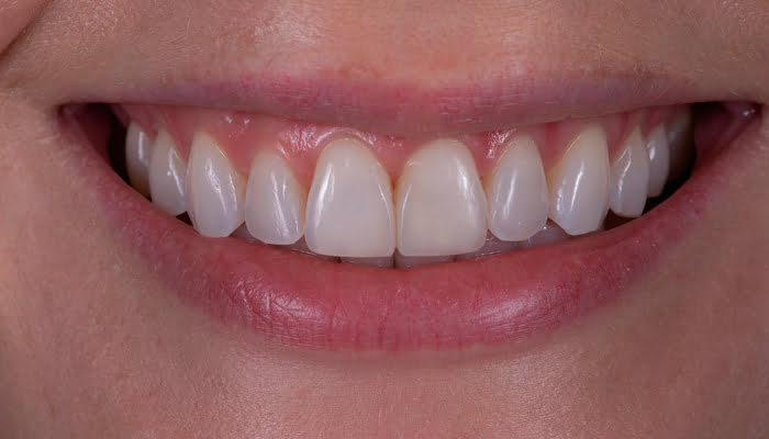 Final aesthetic result of composite restoration polished with DiaShine Lucida clinical case