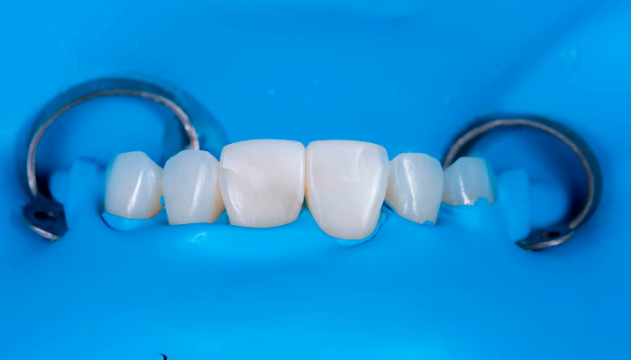 Dentist using DiaShine Lucida polishing system in a clinical case to achieve high-gloss composite restoration surfaces