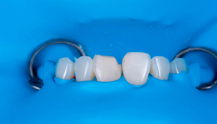 Initial surface finishing of composite restoration using DiaShine Lucida polishing system