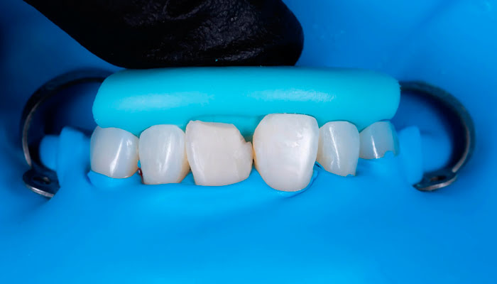 Composite restoration before polishing in DiaShine Lucida clinical case by Dr. Monaldo Saracinelli