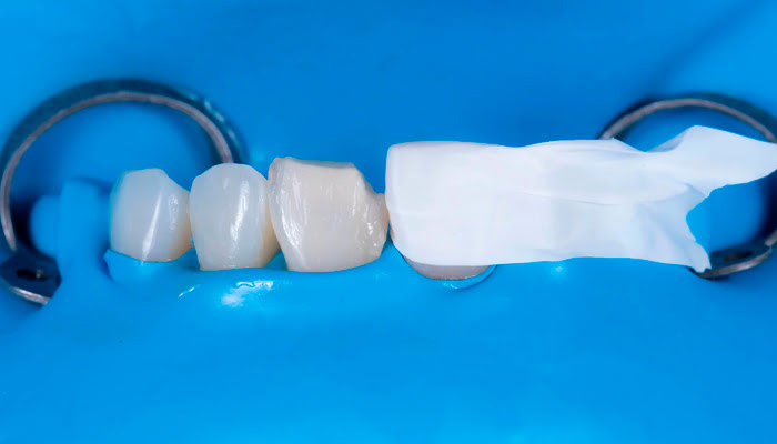 Application of DiaShine Lucida polishing paste during composite restoration finishing