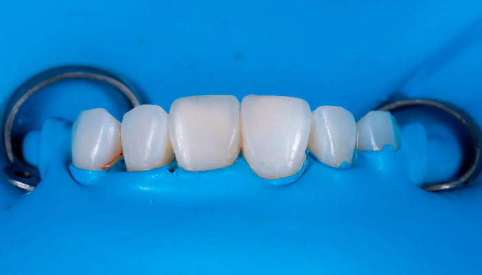 Step by step composite polishing process using DiaShine Lucida system in clinical case