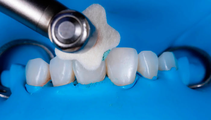 Final polishing stage of composite restoration using DiaShine Lucida clinical protocol