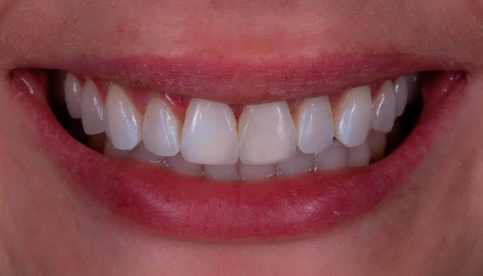 High gloss composite dental restoration after polishing with DiaShine Lucida system
