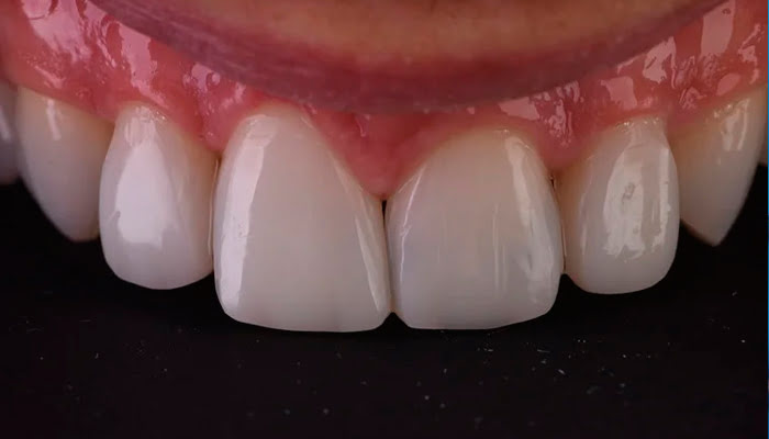 Composite restoration before DiaShine Lucida polishing in clinical case by Nada Albatish
