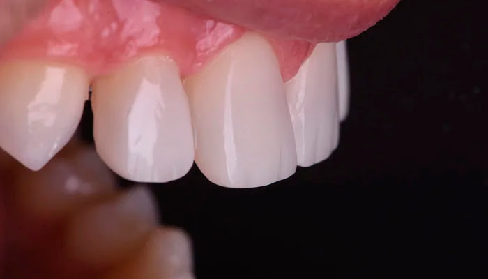 Initial condition of composite restoration prior to polishing with DiaShine Lucida system