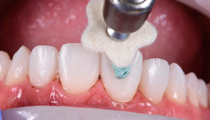 Start of DiaShine Lucida polishing sequence on composite restoration surface