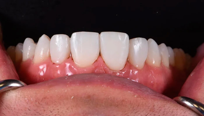 Application of DiaShine Lucida polishing paste during composite finishing steps