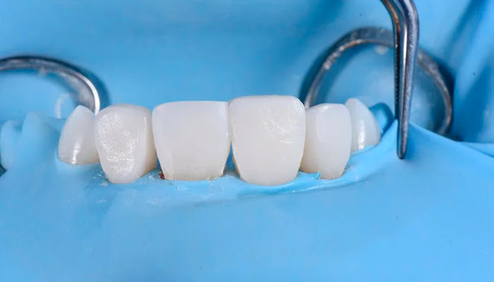 Intermediate polishing stage with DiaShine Lucida system in clinical case by Nada Albatish