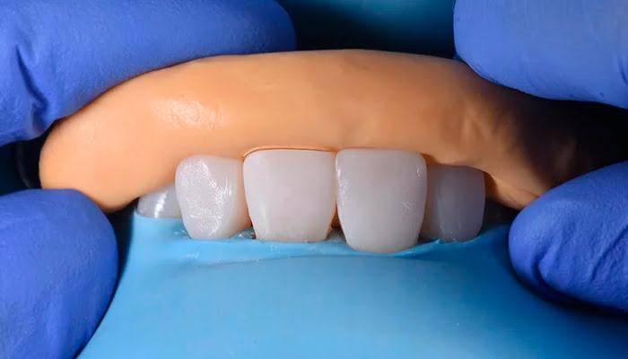 Close up of DiaShine Lucida polishing action during clinical composite restoration finishing