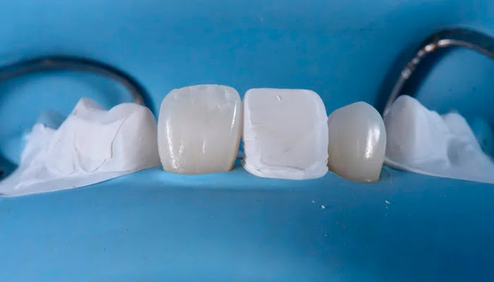 Detailed view of composite surface polishing using DiaShine Lucida system during clinical workflow