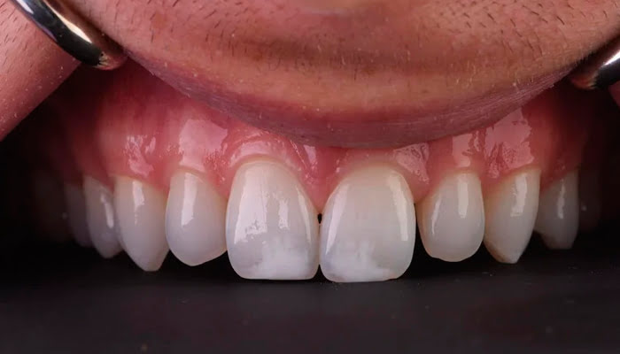 Final high-gloss composite restoration after DiaShine Lucida polishing in clinical case by Nada Albatish