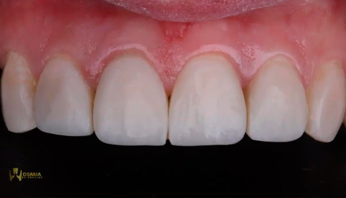 Osama Shaalan demonstrating Lucida polishing technique on composite restoration