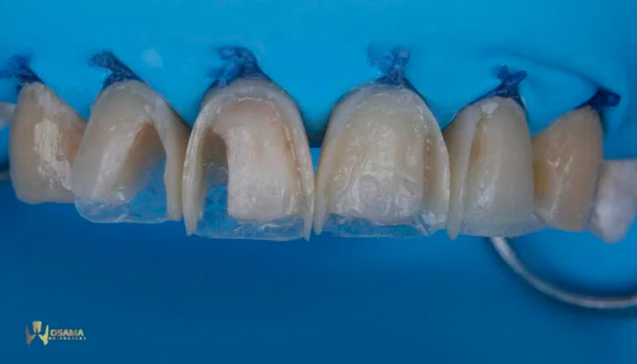 Dentist holding Lucida polishing system components for demonstration