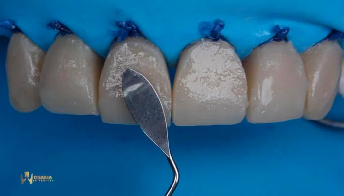 Dentist carefully polishing incisal edge with Lucida system