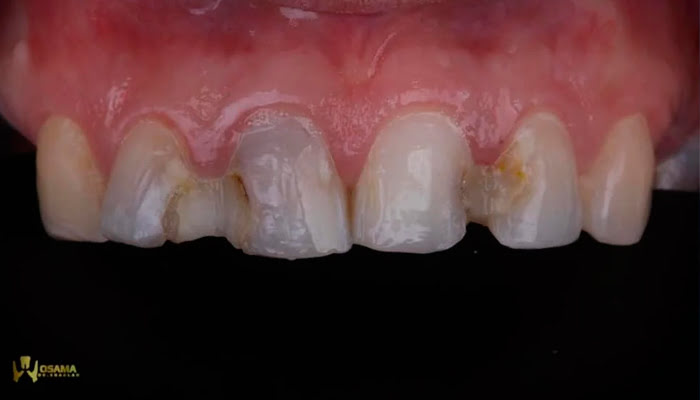 Step-by-step Lucida polishing showing progressive gloss levels
