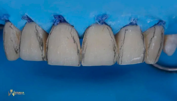 Lucida polishing system used to contour and refine tooth shape