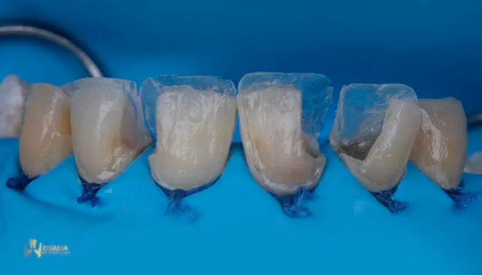 Before and after comparison of composite restoration gloss