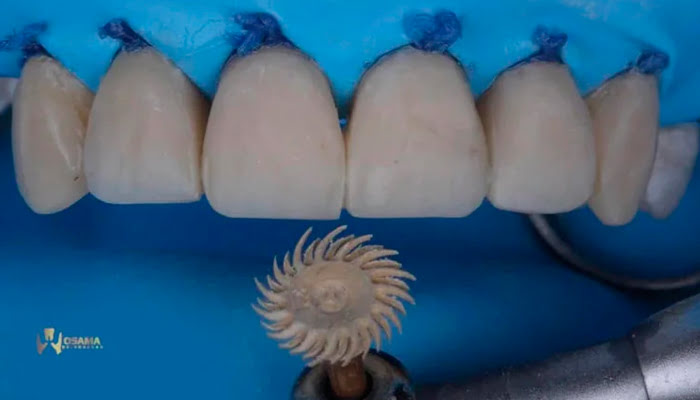 Finished composite restoration with high-gloss achieved using Lucida