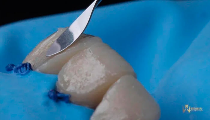 Close‑up of composite anterior tooth before Lucida polishing