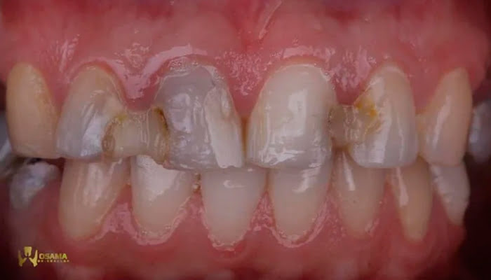 Detail of reflective surface on composite anterior tooth after Lucida polishing