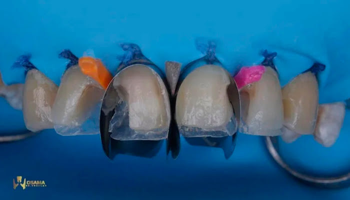 Lucida polishing paste and felt stars demonstrating final finishing results