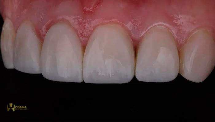 After Lucida polishing high‑gloss finish on composite restoration