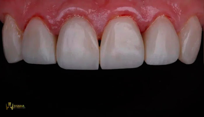 Using Lucida Click felt star for initial composite polishing