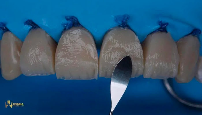 Dentist performing step-by-step Lucida polishing on anterior teeth