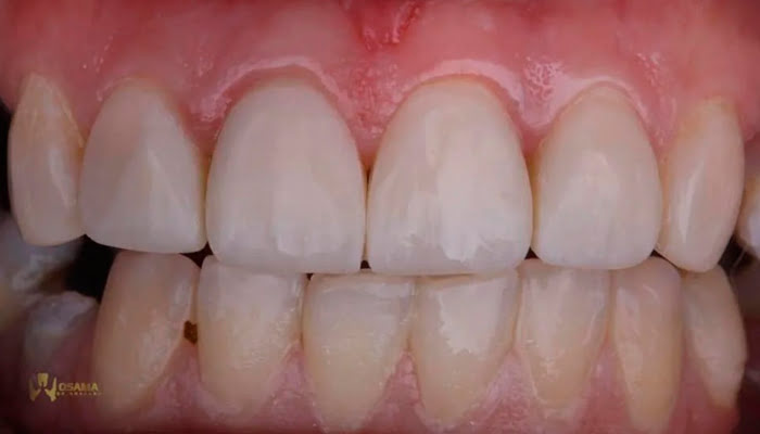 Detail of composite surface after first Lucida polishing stage