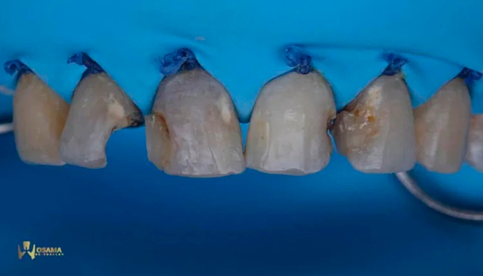 Polishing composite restoration using rotational technique with Lucida